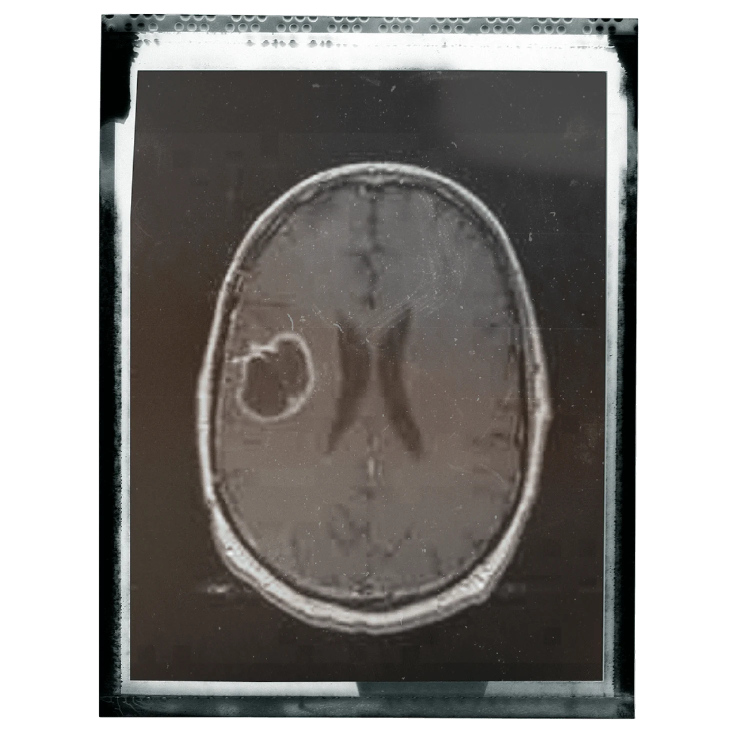 Glioblastoma MRI image, Dr Michele Burklund Story